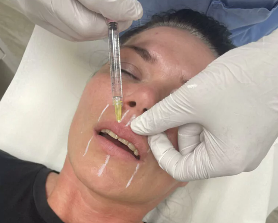 Gesicht einer Frau und eine Hylaruon Spritze die von einem Händen mit Hygienehandschuhen gehalten wird